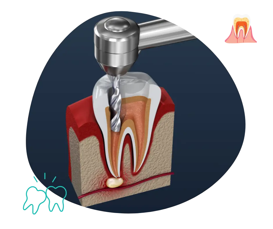 Root Canal Treatment